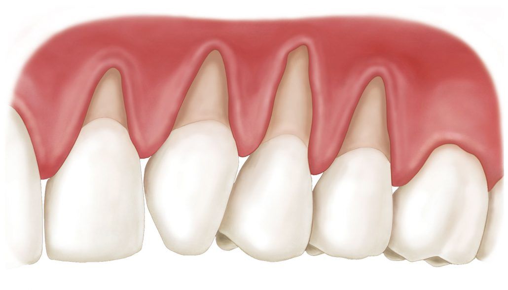 Início 3 Tratamento de recessão gengival com dentista em João Pessoa